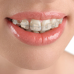 Closeup of teeth with tooth-colored braces and clear wires